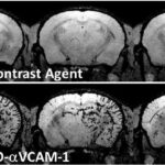 மூளையில் ஏற்படும் அழற்சியை காட்டும் MRI படம்