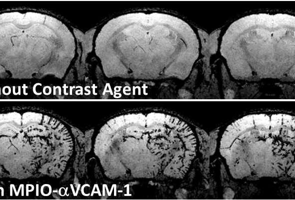 மூளையில் ஏற்படும் அழற்சியை காட்டும் MRI படம்