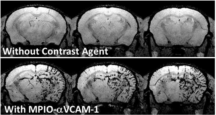 மூளையில் ஏற்படும் அழற்சியை காட்டும் MRI படம்